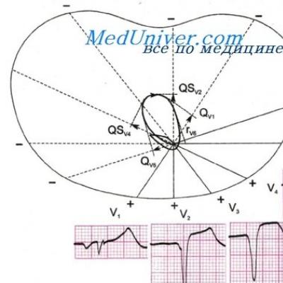 Սրտամկանի շրջանաձև ինֆարկտ Սրտամկանի ինֆարկտի սպիական շրջան